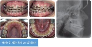 Phân tích case: Niềng răng kết hợp phẫu thuật hàm thành công cho nữ sinh viên 18 tuổi