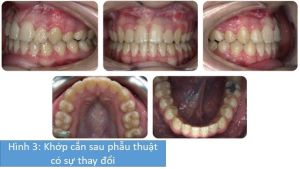 Phân tích case: Niềng răng kết hợp phẫu thuật hàm thành công cho nữ sinh viên 18 tuổi