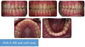 Phân tích case: Niềng răng kết hợp phẫu thuật hàm thành công cho nữ sinh viên 18 tuổi