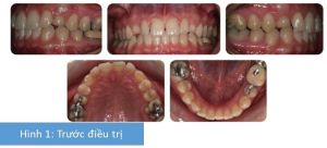 Phân tích case: Niềng răng cho bệnh nhân nữ 26 tuổi vẫn còn răng nanh sữa trong khi răng nanh vĩnh viễn mọc ngầm phía khẩu cái
