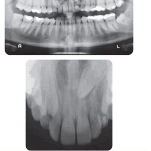 Phân tích case: Niềng răng cho bệnh nhân nữ 26 tuổi vẫn còn răng nanh sữa trong khi răng nanh vĩnh viễn mọc ngầm phía khẩu cái
