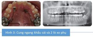 Phân tích case: Niềng răng cho bệnh nhân nữ 26 tuổi vẫn còn răng nanh sữa trong khi răng nanh vĩnh viễn mọc ngầm phía khẩu cái