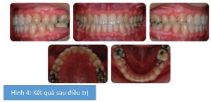 Phân tích case: Niềng răng cho bệnh nhân nữ 26 tuổi vẫn còn răng nanh sữa trong khi răng nanh vĩnh viễn mọc ngầm phía khẩu cái