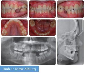 Phân tích case: Niềng răng cho bệnh nhân 14 tuổi có nhiều răng hàm nhỏ không mọc