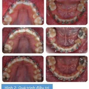 Phân tích case: Niềng răng cho bệnh nhân 14 tuổi có nhiều răng hàm nhỏ không mọc