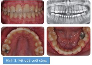 Phân tích case: Niềng răng cho bệnh nhân 14 tuổi có nhiều răng hàm nhỏ không mọc