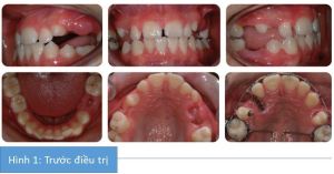 Phân tích case: Niềng răng thành công cho cậu bé 14 tuổi có nhiều răng không mọc