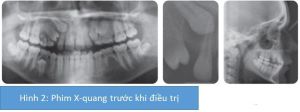 Phân tích case: Niềng răng thành công cho cậu bé 14 tuổi có nhiều răng không mọc