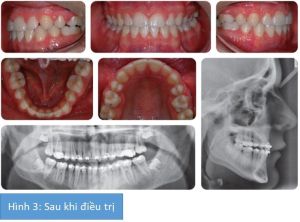 Phân tích case: Niềng răng thành công cho cậu bé 14 tuổi có nhiều răng không mọc