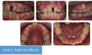 Phân tích case: Niềng răng thành công cho bệnh nhân có răng bất đối xứng, răng cửa thưa, mọc lệch lạc