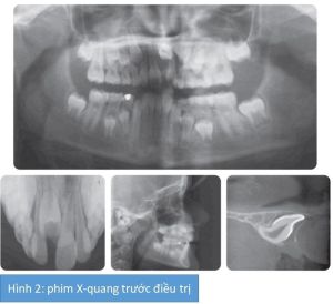 Phân tích case: Niềng răng thành công cho bệnh nhân có răng bất đối xứng, răng cửa thưa, mọc lệch lạc