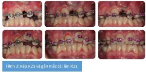 Phân tích case: Niềng răng thành công cho bệnh nhân có răng bất đối xứng, răng cửa thưa, mọc lệch lạc
