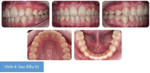 Phân tích case: Niềng răng thành công cho bệnh nhân có răng bất đối xứng, răng cửa thưa, mọc lệch lạc