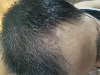 Cấy tóc được 4 tháng nhưng tóc không mọc cũng không rụng
