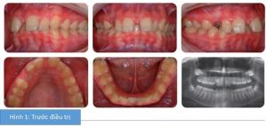 Phân tích case: Niềng răng thành công cho bệnh nhân bị hô nhẹ có phanh môi bám thấp và khe thưa đường giữa