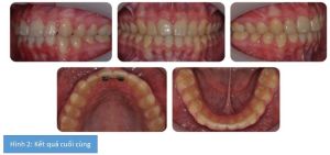Phân tích case: Niềng răng thành công cho bệnh nhân bị hô nhẹ có phanh môi bám thấp và khe thưa đường giữa