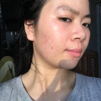 Sản phẩm trị sẹo nào tốt cho da mỏng?