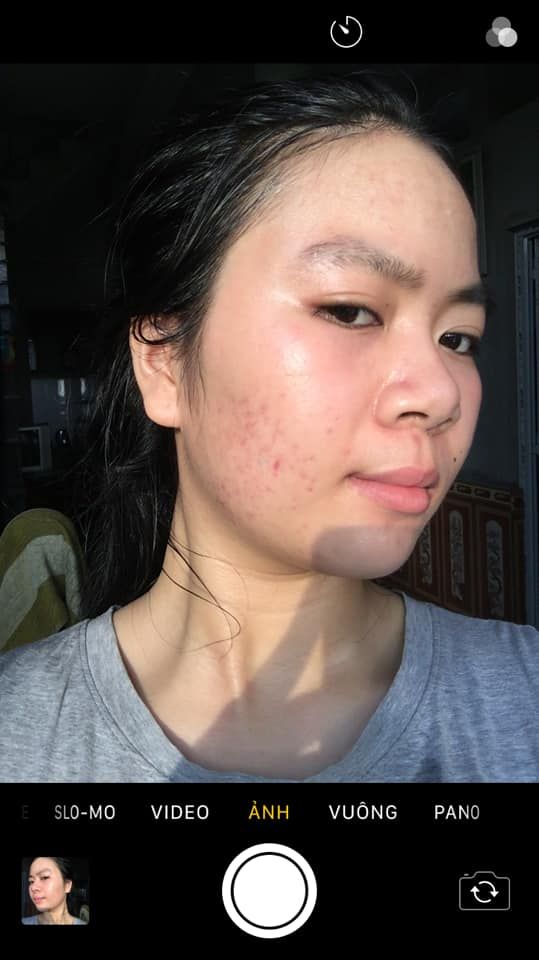 Sản phẩm trị sẹo nào tốt cho da mỏng? Sản phẩm trị sẹo nào tốt cho da mỏng?