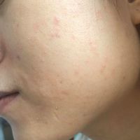 Không biết có phải bị mụn do dị ứng hay kích ứng?