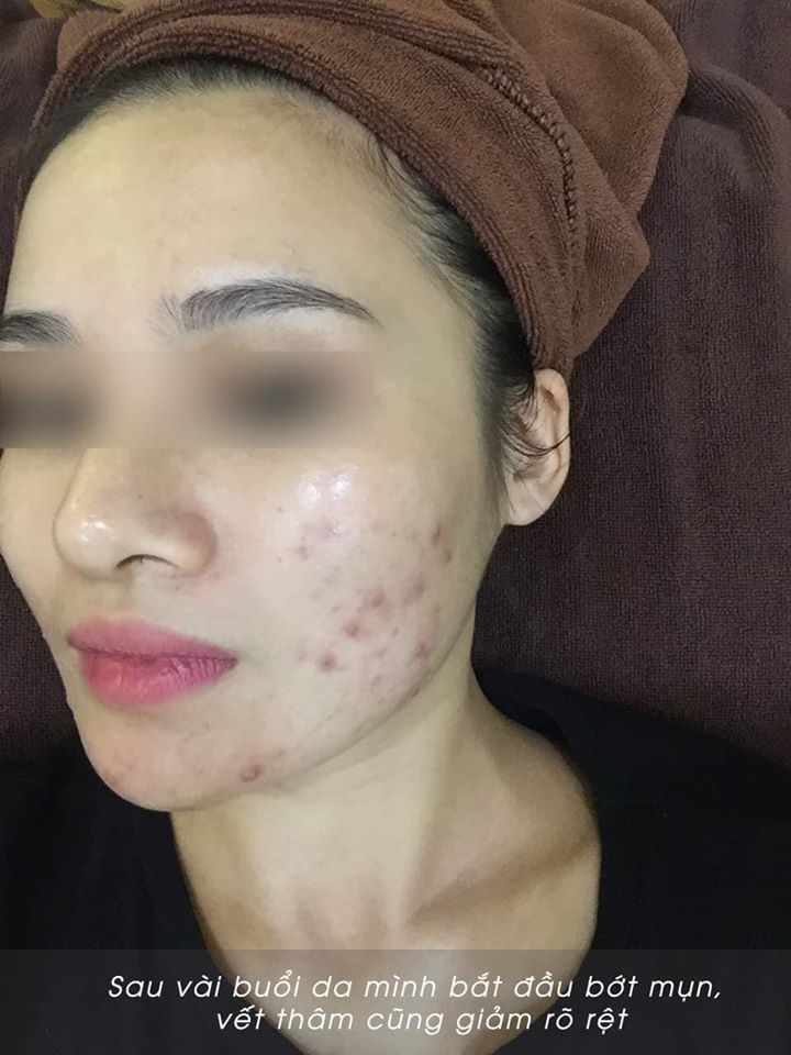 Mình đã điều trị dứt điểm mụn sưng viêm lâu năm như thế nào?
