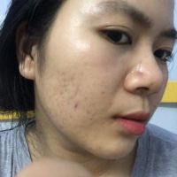 Sản phẩm trị sẹo nào tốt cho da mỏng?