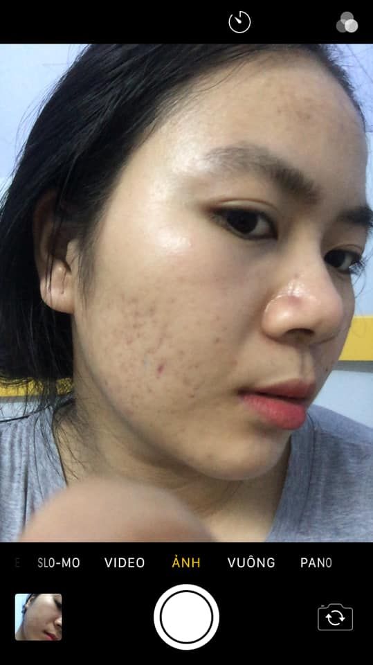 Sản phẩm trị sẹo nào tốt cho da mỏng? Sản phẩm trị sẹo nào tốt cho da mỏng?