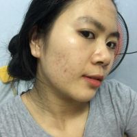 Sản phẩm trị sẹo nào tốt cho da mỏng?