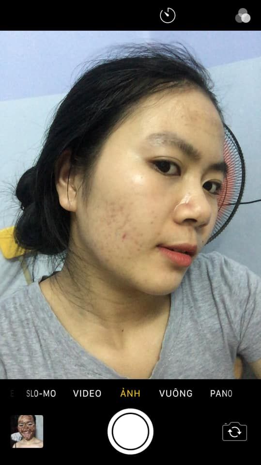 Sản phẩm trị sẹo nào tốt cho da mỏng? Sản phẩm trị sẹo nào tốt cho da mỏng?