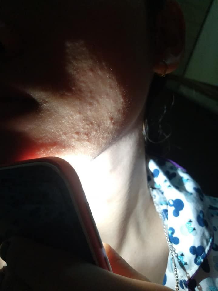 Skincare chưa đúng khiến mặt nổi mụn