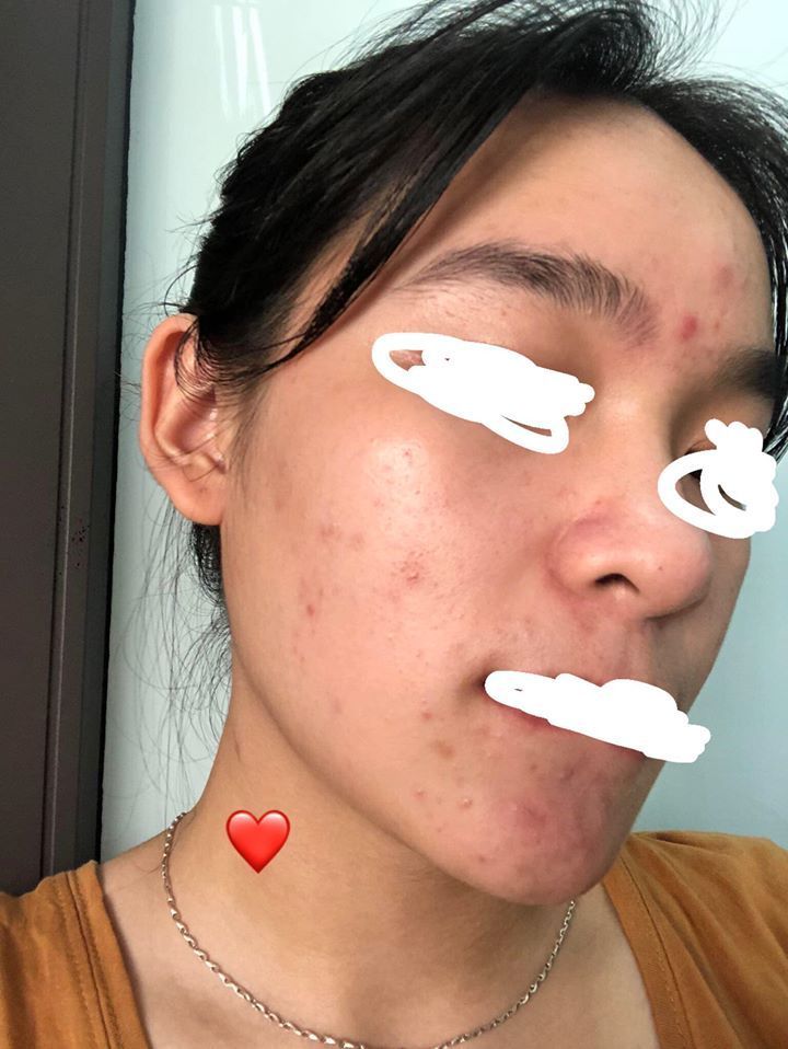 Giúp bạn đang bị stress vì mặt mụn