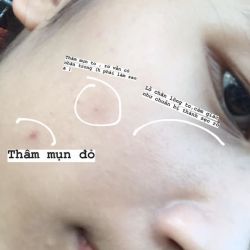 Nên dùng hay bỏ sản phẩm trị thâm nào?
