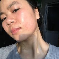 Sản phẩm trị sẹo nào tốt cho da mỏng?