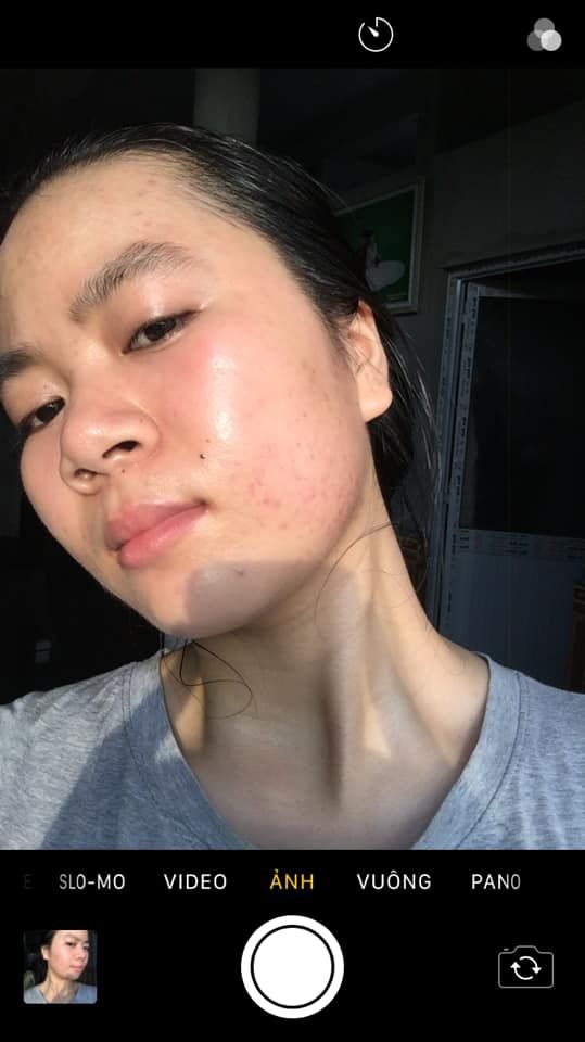 Sản phẩm trị sẹo nào tốt cho da mỏng? Sản phẩm trị sẹo nào tốt cho da mỏng?