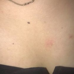 Mụn trắng nhỏ mọc thành từng cụm phải làm sao?