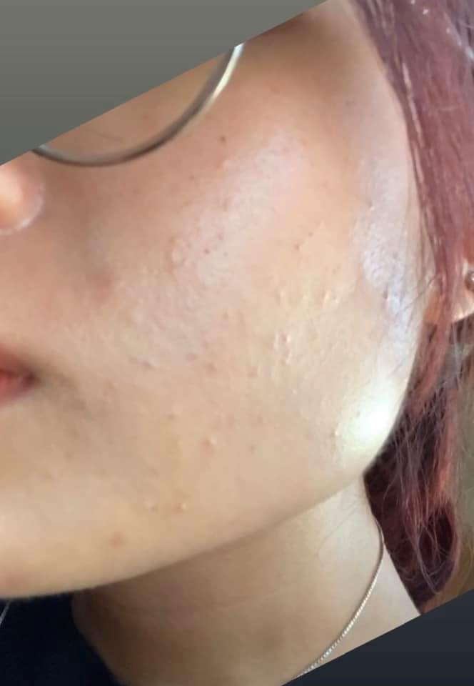 Chăm sóc da mặt đúng cách để không bị lên mụn?