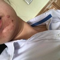 Mụn nội tiết ở cằm và trán đã 10 năm phải làm sao?