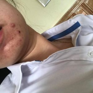 Mụn nội tiết ở cằm và trán đã 10 năm phải làm sao?