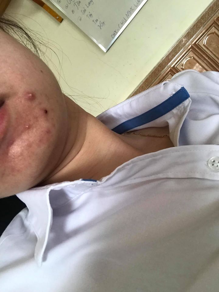 Mụn nội tiết ở cằm và trán đã 10 năm phải làm sao? Mụn nội tiết ở cằm và trán đã 10 năm phải làm sao?
