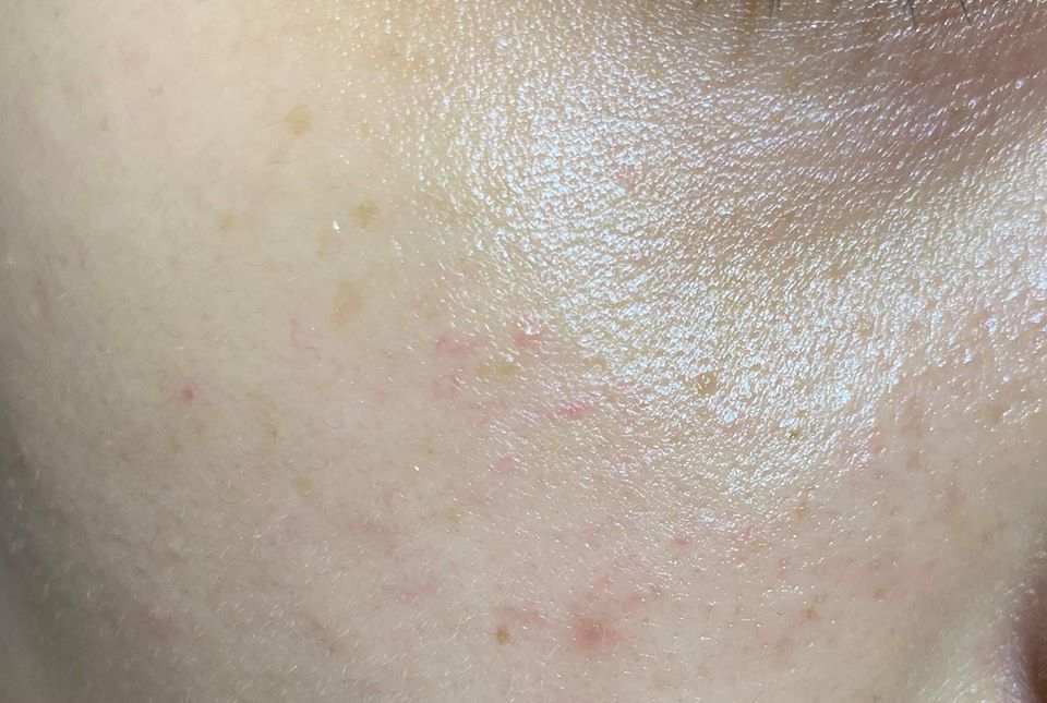 Cách chăm sóc da bị nám nhẹ