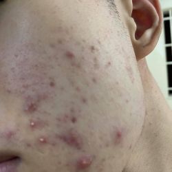 Tìm phương án trị mụn?