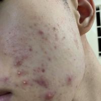 Bị mụn 3 năm rồi chữa trị không khỏi Bị mụn 3 năm rồi chữa trị không khỏi