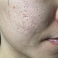 Tư vấn và giới thiệu sản phẩm trị sẹo rỗ