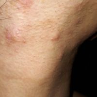 Trị khỏi mụn nội tiết nặng mọc ở các vùng như má, quai hàm, thái dương như thế nào?