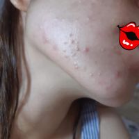 Mụn ẩn hay mụn nội tiết? Hướng điều trị thế nào? Mụn ẩn hay mụn nội tiết? Hướng điều trị thế nào?