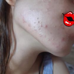 Mụn ẩn hay mụn nội tiết? Hướng điều trị thế nào?