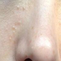 Cách chữa mụn thịt bên cánh mũi?