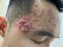 Tìm phương án trị mụn?