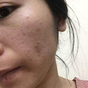 Môi khô và da mụn phải làm sao?