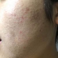 Skincare thế nào để da không bị khô, ngứa, mụn?