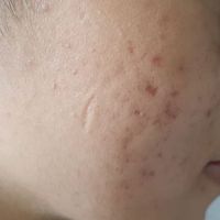 Giới thiệu sản phẩm cải thiện làn da thâm, sẹo lõm?